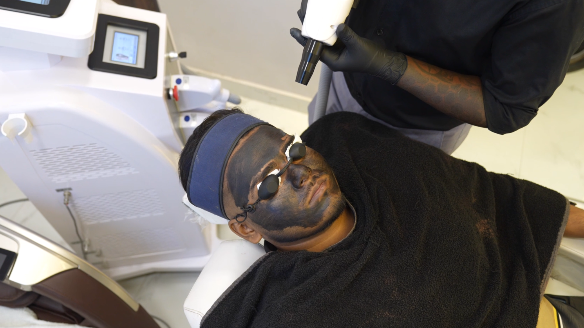 CARBON PEEL