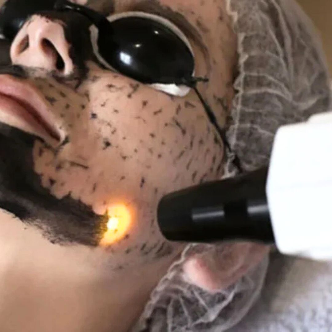 Best Facial Laser Treatment