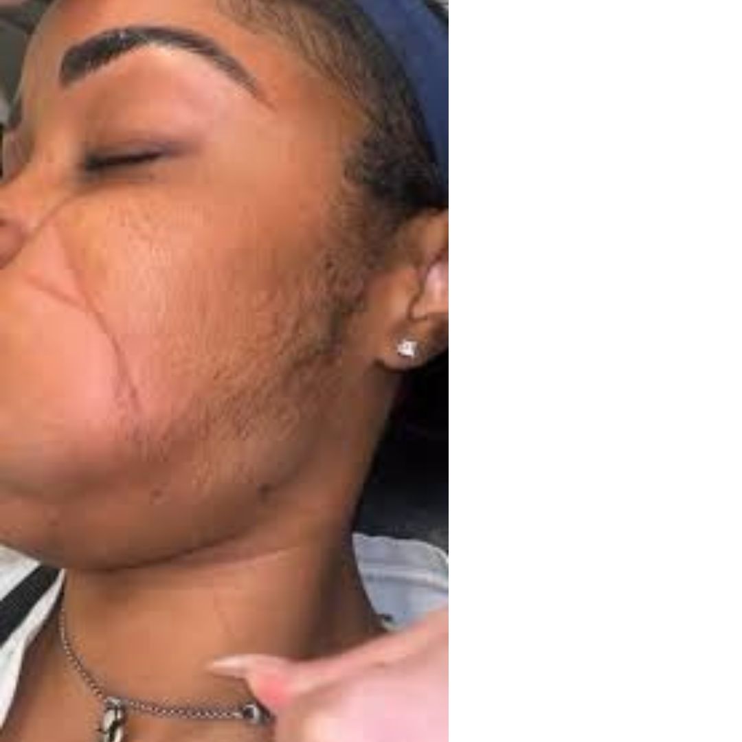 Best Guidance For Face Threading Side Effects