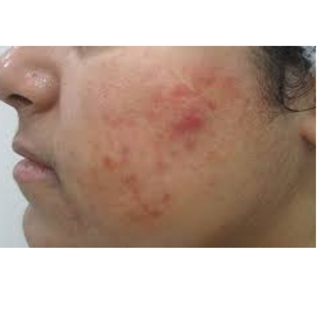 Best Pimples Treatment At Home